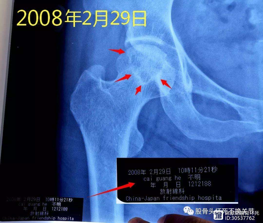 南宁人工骨头医保报销多少(人工骨头医保报销多少比例)